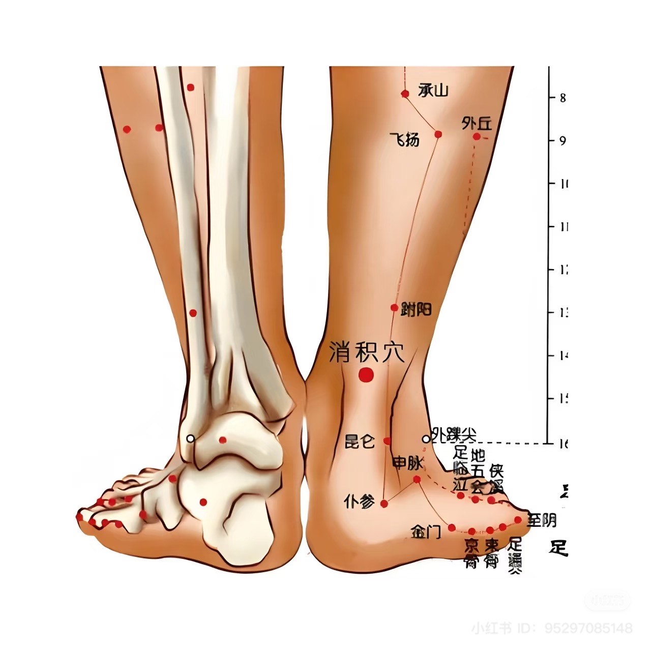 Heel Pain (Plantar Fasciitis): How Acupuncture Can Help